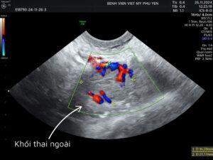 khối thai ngoài tử cung